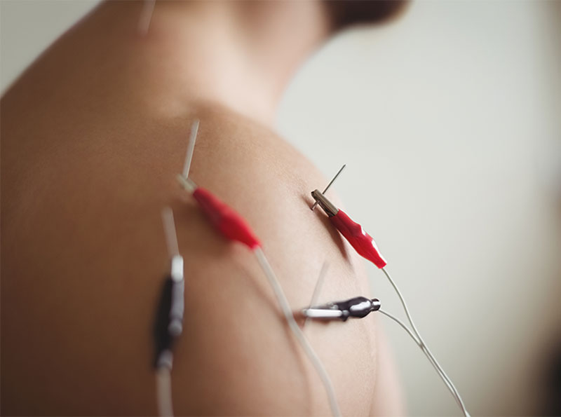 Dry Needling
