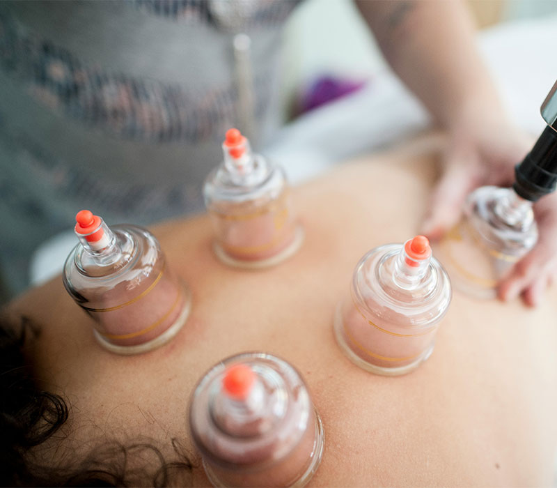 Cupping Therapy